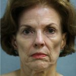 Facelift Before & After Patient #9249