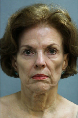 Facelift Before & After Patient #9249