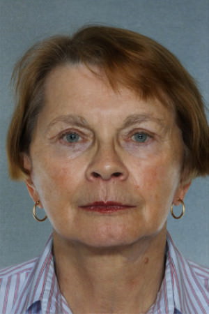 Facelift Before & After Patient #9254