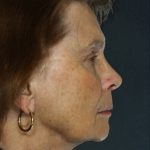 Facelift Before & After Patient #9254