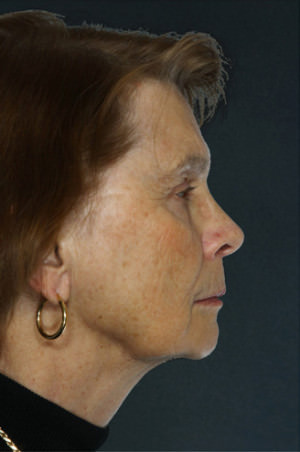 Facelift Before & After Patient #9254