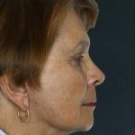 Facelift Before & After Patient #9254