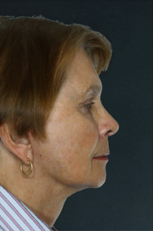 Facelift Before & After Patient #9254