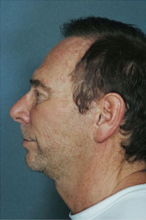 Facelift Before & After Patient #9264