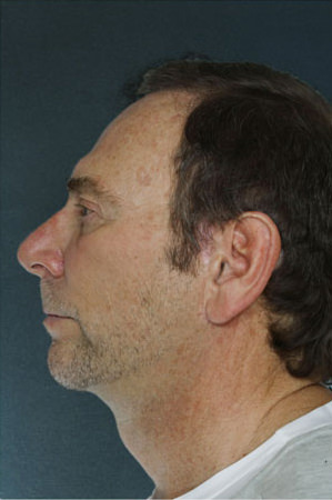 Facelift Before & After Patient #9264