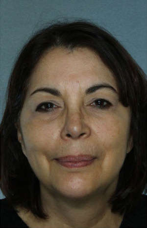 Facelift Before & After Patient #9269