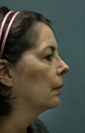 Facelift Before & After Patient #9269