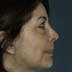 Facelift Before & After Patient #9269