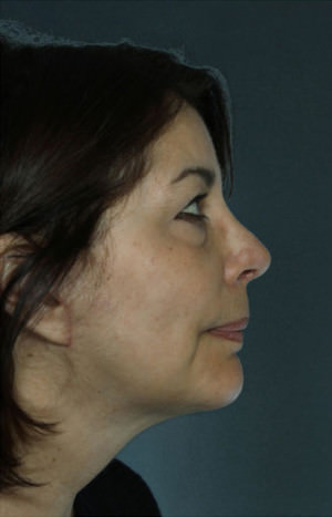 Facelift Before & After Patient #9269