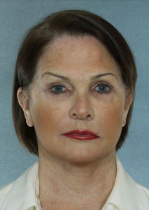 Facelift Before & After Patient #9274