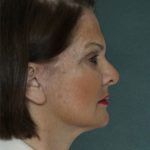 Facelift Before & After Patient #9274