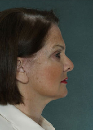 Facelift Before & After Patient #9274