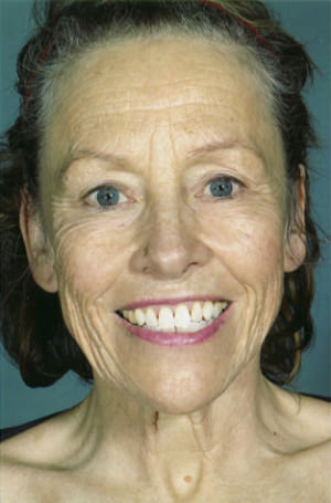 Facelift Before & After Patient #9279