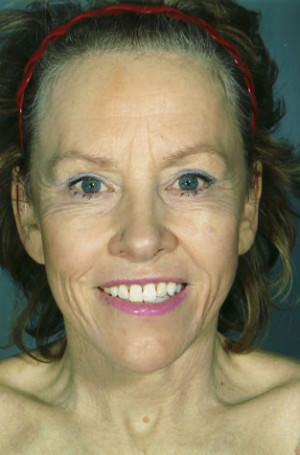 Facelift Before & After Patient #9279