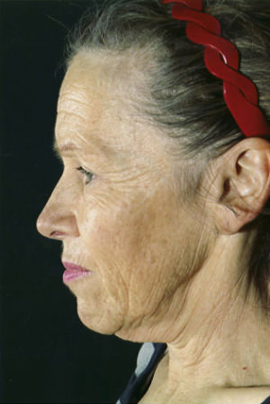 Facelift Before & After Patient #9279