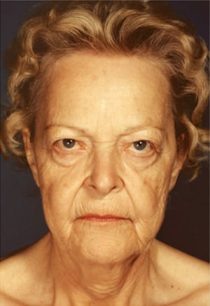 Facelift Before & After Patient #9294