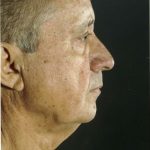 Facelift Before & After Patient #9299