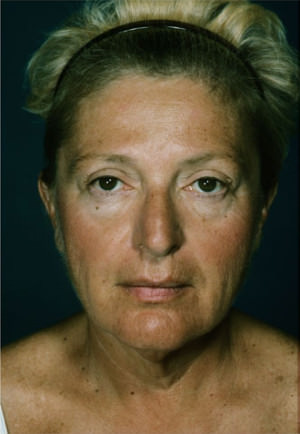 Facelift Before & After Patient #9304