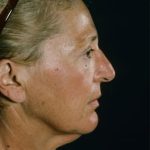 Facelift Before & After Patient #9304