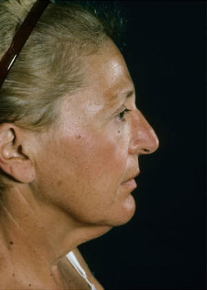 Facelift Before & After Patient #9304