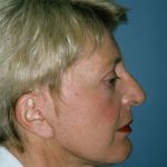 Facelift Before & After Patient #9304