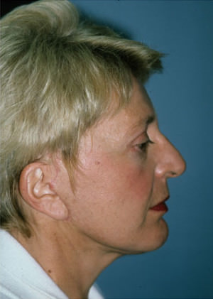 Facelift Before & After Patient #9304