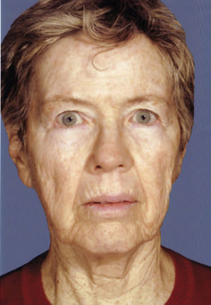 Facelift Before & After Patient #9309