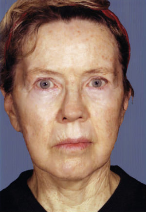 Facelift Before & After Patient #9309