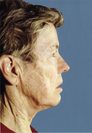 Facelift Before & After Patient #9309
