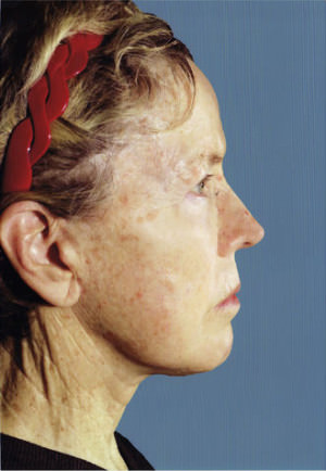 Facelift Before & After Patient #9309