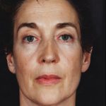 Facelift Before & After Patient #9314