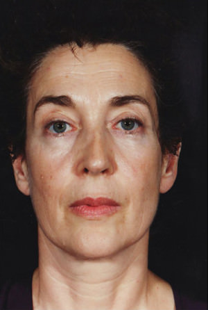 Facelift Before & After Patient #9314