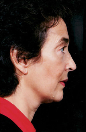 Facelift Before & After Patient #9314