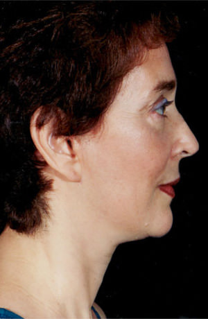 Facelift Before & After Patient #9314