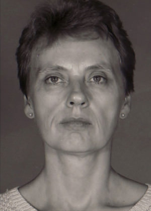 Facelift Before & After Patient #9319