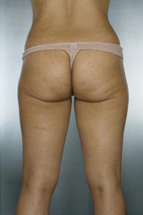 Liposuction Before & After Patient #8524