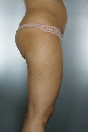 Liposuction Before & After Patient #8524