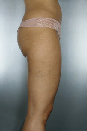 Liposuction Before & After Patient #8524