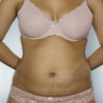 Liposuction Before & After Patient #8524