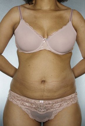 Liposuction Before & After Patient #8524