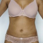 Liposuction Before & After Patient #8524