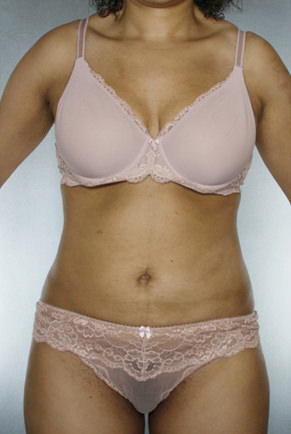 Liposuction Before & After Patient #8524