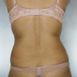 Liposuction Before & After Patient #8524