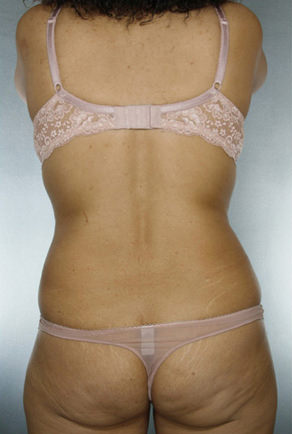 Liposuction Before & After Patient #8524