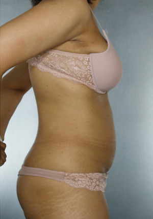 Liposuction Before & After Patient #8524