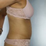 Liposuction Before & After Patient #8524