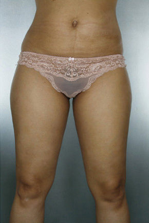 Liposuction Before & After Patient #8524