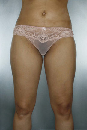 Liposuction Before & After Patient #8524