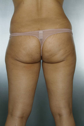 Liposuction Before & After Patient #8524