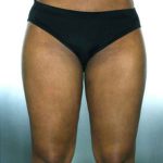 Liposuction Before & After Patient #8537